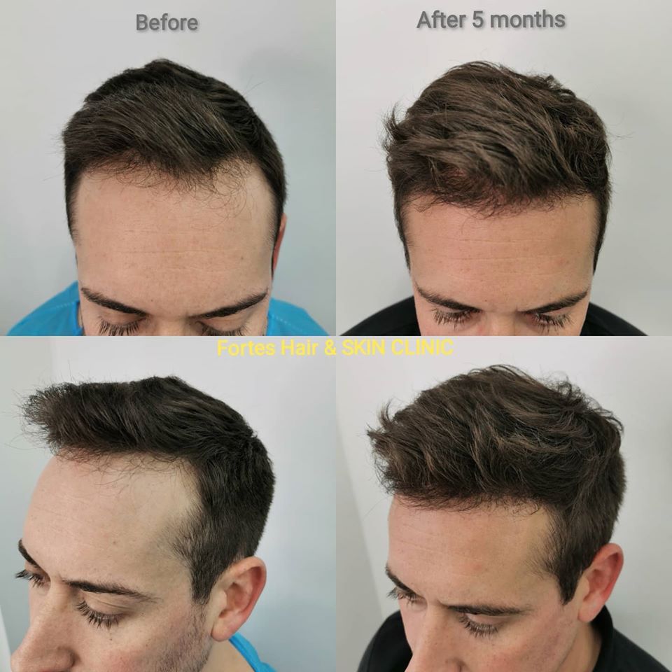 Hair Loss Treatment for Men | Fortes Clinic